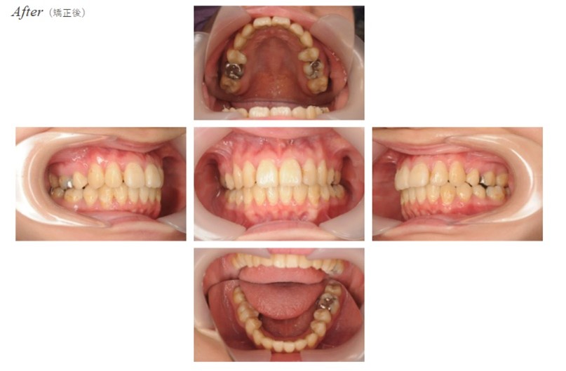 上顎前突After