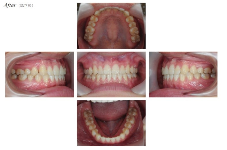 空隙歯列After