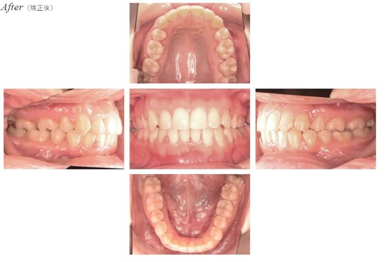 空隙歯列After