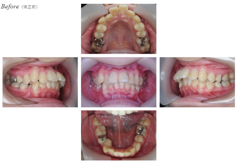 上顎前突Before