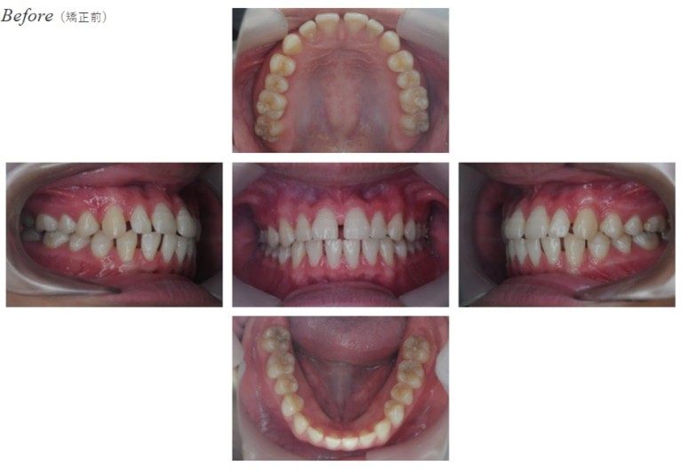 空隙歯列Before