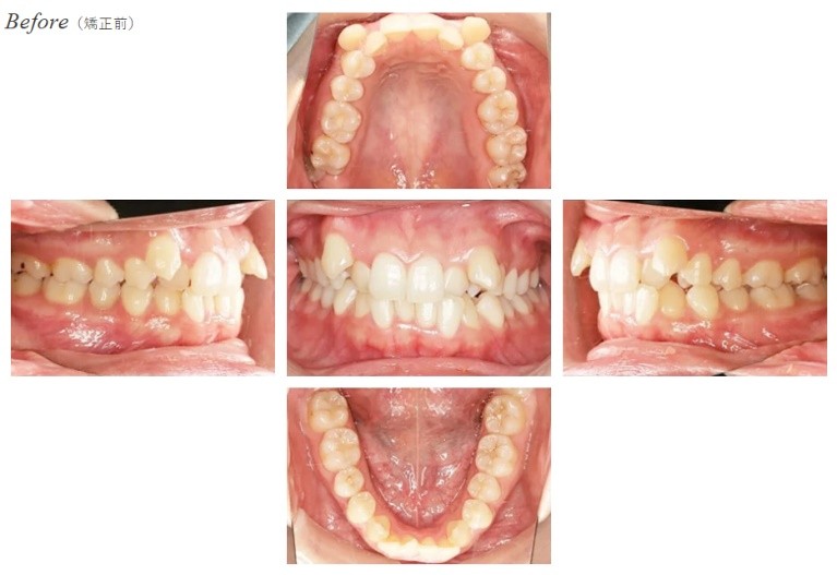空隙歯列Before
