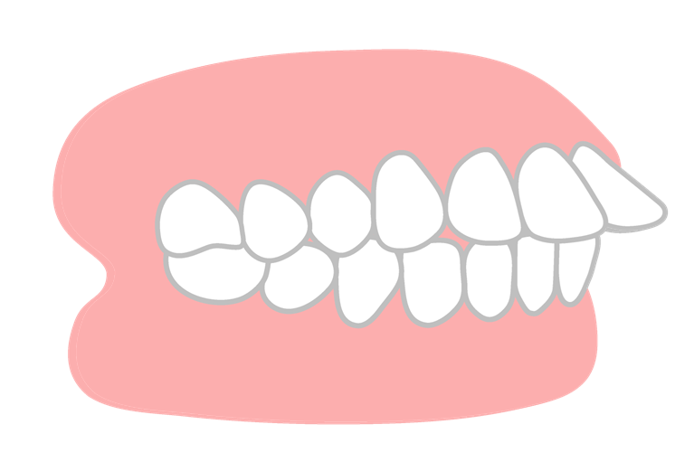 出っ歯はどこからが出っ歯になるのか