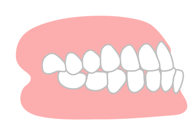 下顎が上顎より前に突き出ている