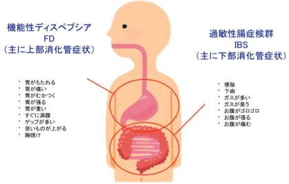 IBSとSIBOとFDは病態が近く間違われやすい