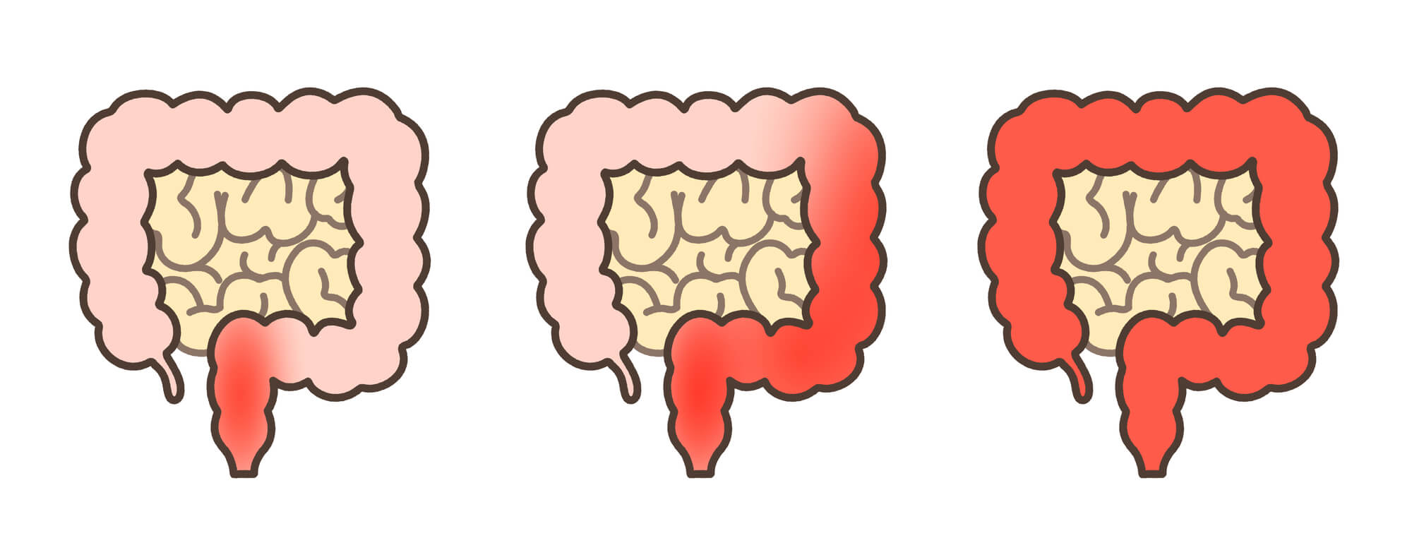 潰瘍性大腸炎